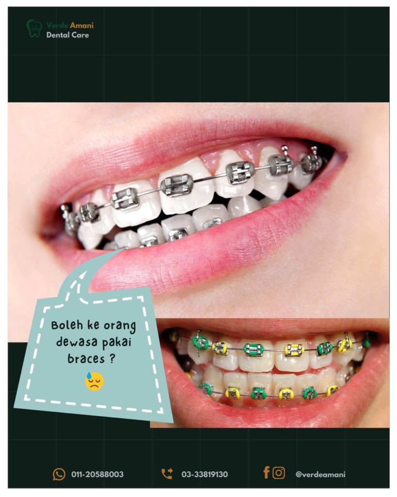 harga pasang braces swasta 1