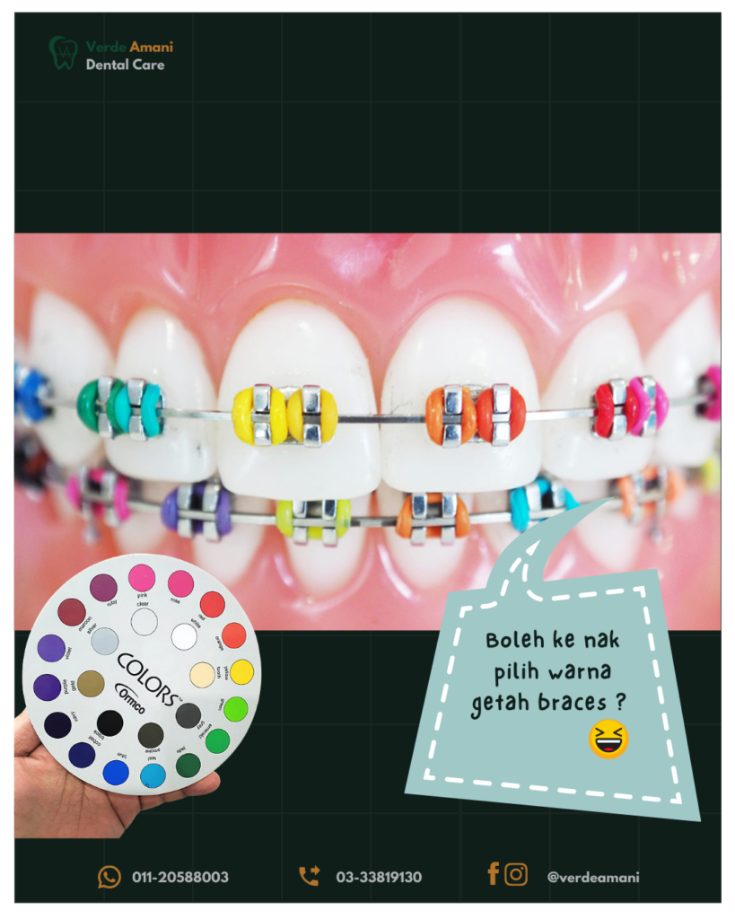 harga pasang braces swasta tips pilih warna